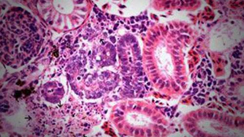 干细胞大战红斑狼疮：间充质干细胞临床可期.jpg